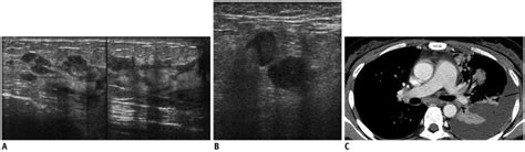 40 Year Old Woman With Metastatic Lung Cancer A Us Of Left Breast