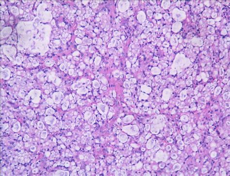 Rhinoscleroma Presenting As Nasal Mass A Case Report Semantic Scholar