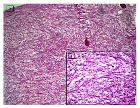 A And B Inset Shows Increased Who Grade Iii Fibrosis On Reticulin