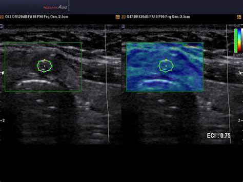 Isthmus Thyroid Ultrasound