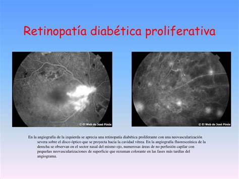 PPT RETINOPAT Í A DIABÉTICA PowerPoint Presentation free download