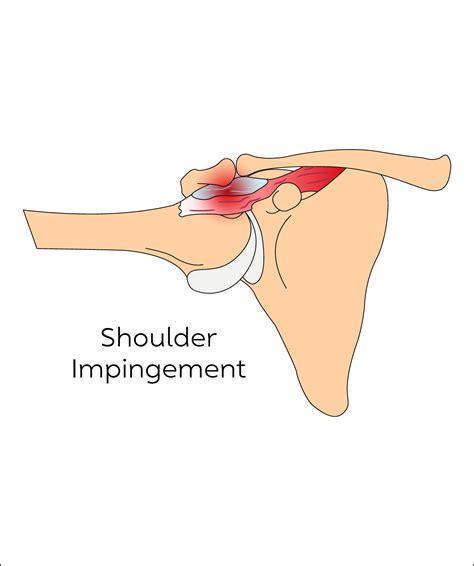 Ultrasound-Guided Joint Injections London | Rejuvence Clinic