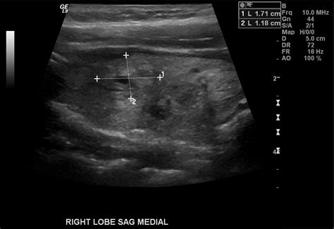 Thyroid Ultrasound