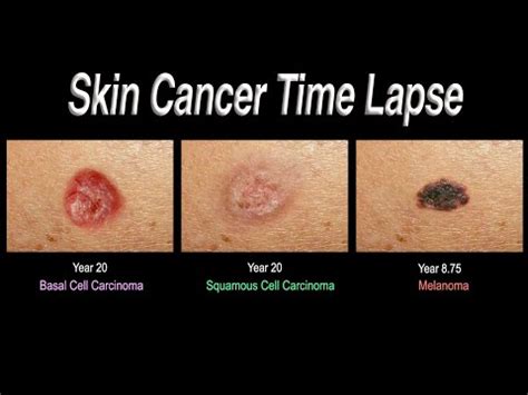 Skin Cancer Time Lapse (Basal Cell Carcinoma, Squamous Cell Carcinoma, Melanoma)