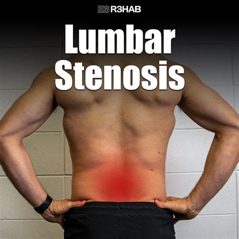 Lumbar Stenosis - E3 Rehab