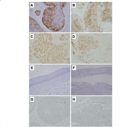 Tff Protein Expression In Escc And Healthy Esophagus Representative