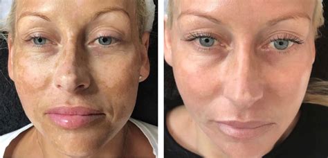 Newlife Aesthetics Clinic Cosmelan Deep Pigmentation Treatment