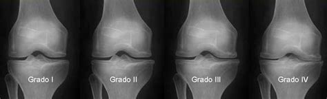 Poco Claro Temerario Hacer La Cena Rodilla Con Artrosis Radiografia