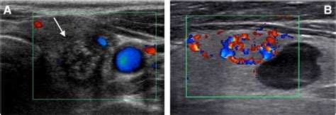 Ultrasound Guided Thyroid Nodule Biopsy Outcomes And Correlation With Imaging Features