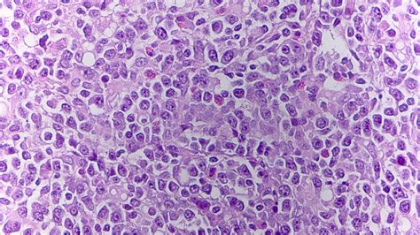 Pathology Outlines - Plasmablastic lymphoma