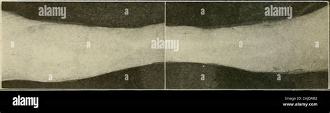 Plastic Surgery Its Principles And Practice Fig Unstable Scar