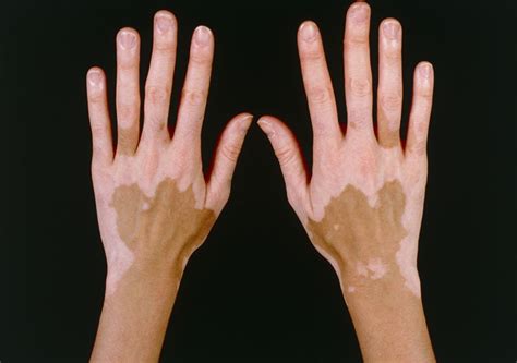 An Approach To Hypopigmentation The Bmj