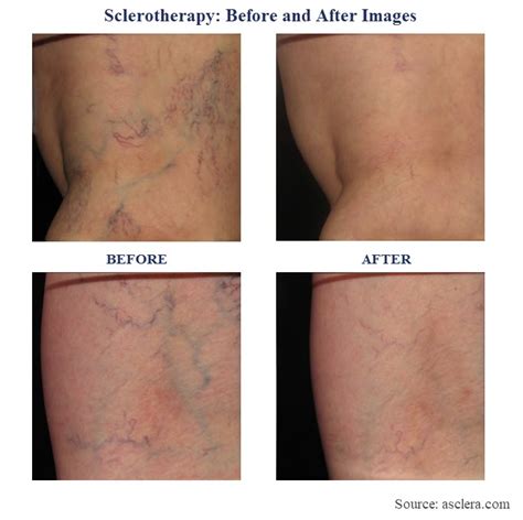 Treatment For Spider Veins