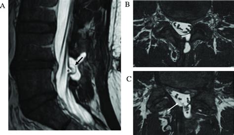 Post Operative Pseudomeningocele With Nerve Root Tethering Sagittal