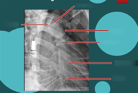 Rao Sternum Diagram Quizlet