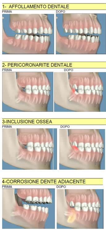 Denti Inclusi Inclusione Dentale