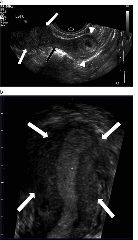 Figure 5 From Sonographic Findings Of Early Pregnancy In The Rudimentary Horn Of A Unicornuate