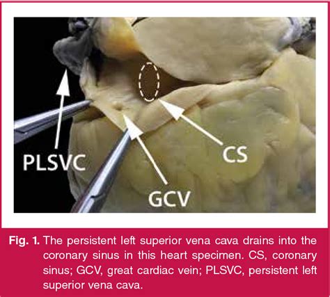 [pdf] Persistent Left Superior Vena Cava Semantic Scholar