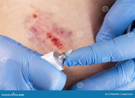 Doctors Hands in Gloves Performs the Treatment the Wound with the Help ...