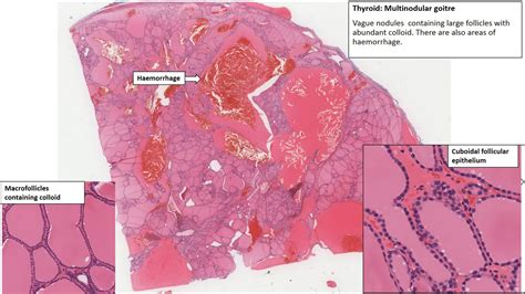 Thyroid Multinodular Goitre Nus Pathweb Nus Pathweb