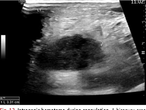 Figure 12 From Multiparametric Ultrasound For Upper Extremity Dialysis