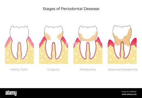 Stages Of Periodontal Disease Illustration Stock Photo Alamy