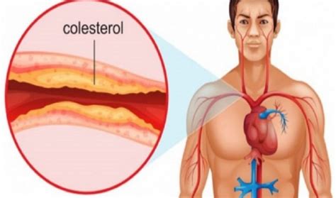 Simptomat e kolesterolit të lartë që nuk duhen neglizhuar Top Channel