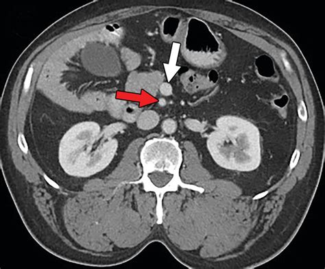 Ligament Du Cadavre De Treitz