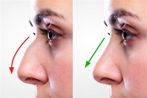 Cosmetic Surgery for the Nose - Urgent Care Blog