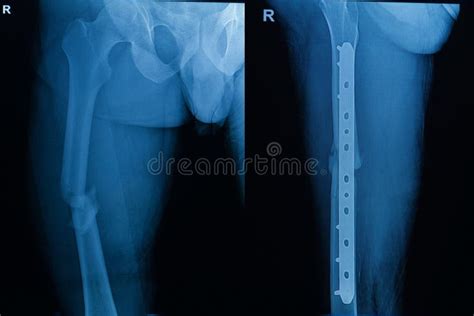 Human X Rays Showing Fracture Of Right Leg Stock Image Image Of Care