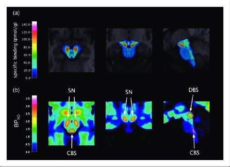 A [ 3 H]az10419369 Arg Binding In The Brainstem Transformed To Mni