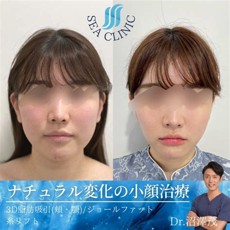 洗練された女性へ。脂肪吸引×糸リフトで小顔を創る。 Sea Clinic −シークリニック 銀座― 理想を叶える小顔治療