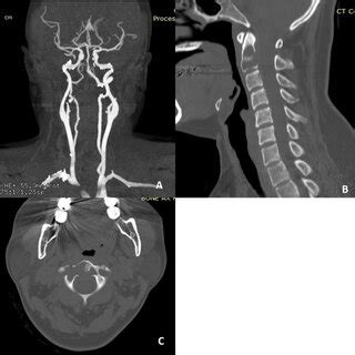 Preoperative Plain Cervical Spine Radiograph Showing Loss Of Cervical