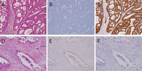 Absence Of High Risk Human Papillomavirus Hpv Detection In