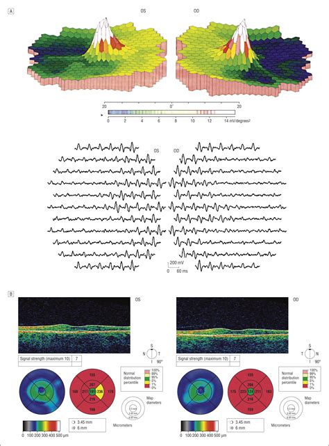 Bitemporal Hemianopia Caused By Retinal Disease Ophthalmology Jama