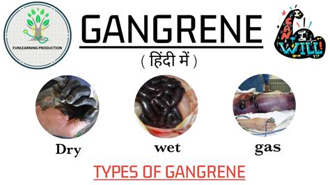 Gangrene And It S Types Cell Injury Part Youtube