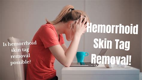 Hemorrhoid Skin Tag