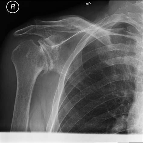 Broken Shoulder X Ray