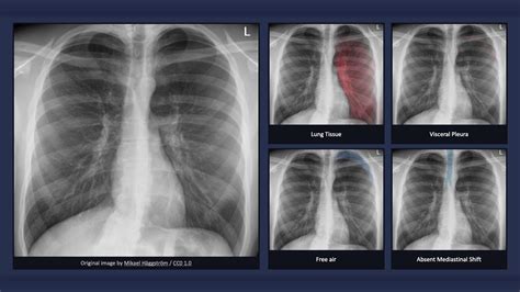 Underexposed Chest X Ray Telegraph