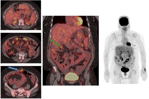 55 Years Old Female Diagnosed Mucinous Carcinoma Ovary Status Tah And