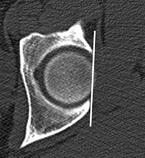 6 Acetabular retroversion as measured on axial CT image through the... | Download Scientific Diagram