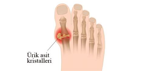 Ayak Parmağı Ağrısı Belirtileri ve Tedavisi