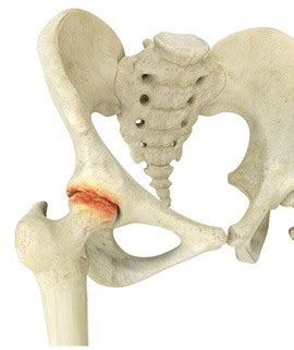 Hip Arthritis Treatment Chicago IL Hip Osteoarthritis Treatment