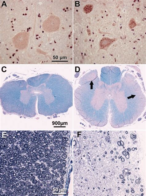 Dm Affected Spinal Cords Display Sod1 Positive Aggregates In Motor