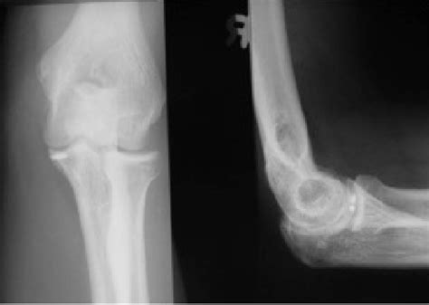 Anteroposterior radiograph of suture anchor placement. | Download ...