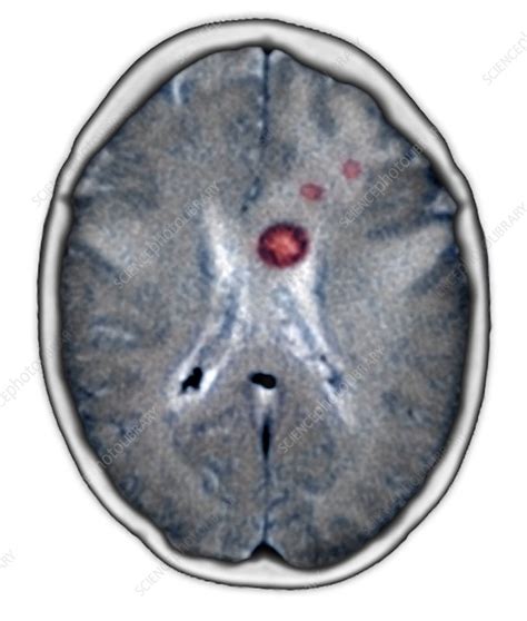 Secondary Brain Cancers Ct Scan Stock Image M Science