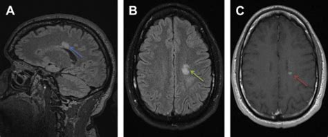 Visual Issues In Multiple Sclerosis Musculoskeletal Key