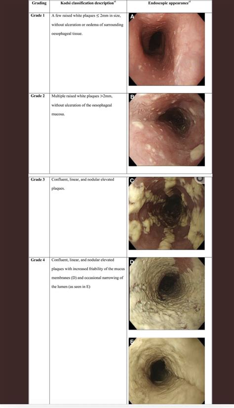 Review Infectious Esophagitis Gutsandgrowth