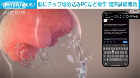 脳にチップを埋め込みpcなど操作する技術 臨床試験を開始 ライブドアニュース