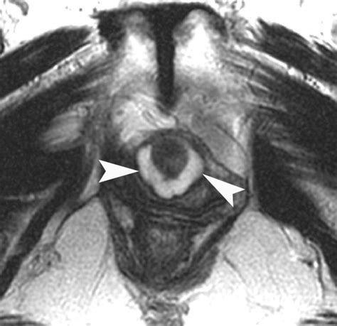 Mr Imaging Of The Female Urethra And Supporting Ligaments In Assessment